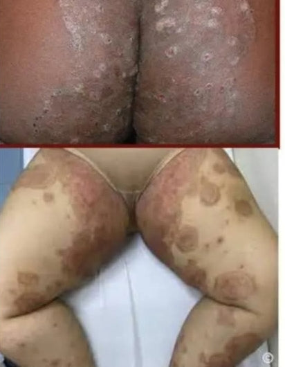 Golden Skin Care – Daad, Khujli, Pimples, Muhase ka 100% Guaranteed Ilaj. Sabhi Skin Problems ka Ek Hi Solution.