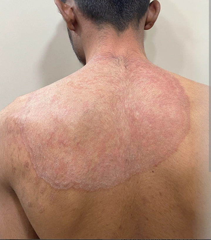 Golden Skin Care – Daad, Khujli, Pimples, Muhase ka 100% Guaranteed Ilaj. Sabhi Skin Problems ka Ek Hi Solution.