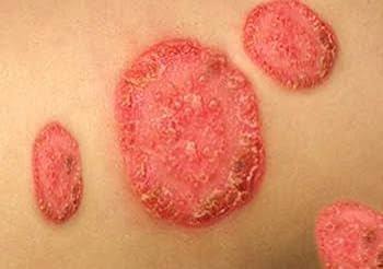 Golden Skin Care – Daad, Khujli, Pimples, Muhase ka 100% Guaranteed Ilaj. Sabhi Skin Problems ka Ek Hi Solution.